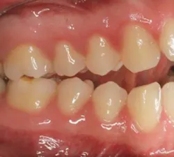 Classiiocclusionexercisemsh Classiiocclusionexercisemsh