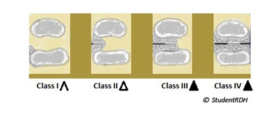 Glickmansfurcationclassificationmsh