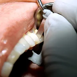 Contacez Acpfig3 Contacez Acpfig3