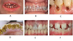 Teeth Staining chart Teeth Staining chart