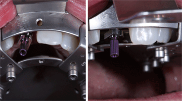 Content Dam Diq Online Articles 2016 07 Pmm Pdt Implantimp Diqthumb