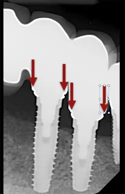 Pmm Pdt Implantimp Fig01 Pmm Pdt Implantimp Fig01