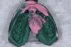 Pmm Pdt Implantimp Fig10 Pmm Pdt Implantimp Fig10