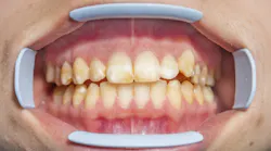 Content Dam Diq Online Articles 2016 11 Fluorosis Diqthumb Content Dam Diq Online Articles 2016 11 Fluorosis Diqthumb