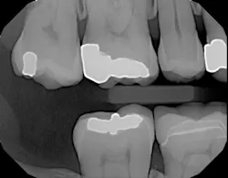 Dexis 05172017 Ar4 Picture1 Dexis 05172017 Ar4 Picture1