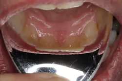 Pmm Reflective Shields Plus Fig02 Pmm Reflective Shields Plus Fig02