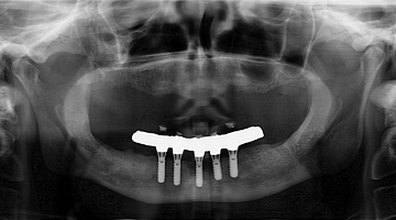 Content Dam Diq Online Articles 2017 09 17sept7bcwhatimplant Thumb