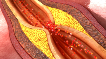 Content Dam Diq Online Articles 2017 10 Atherosclerosis Dreamstime Thumbnail