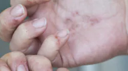 Content Dam Diq Online Articles 2018 08 Dermatitis Hands Auger Diqthumb Content Dam Diq Online Articles 2018 08 Dermatitis Hands Auger Diqthumb