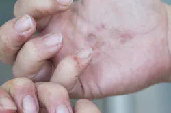 Dermatitis Hands Auger Dermatitis Hands Auger