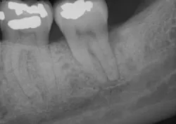 Fortune Endoscopy Casereview 18 Preop 500w Fortune Endoscopy Casereview 18 Preop 500w