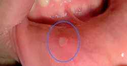 Figure 2: Unknown oral lesion Figure 2: Unknown oral lesion