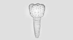 Content Dam Diq Online Articles 2019 02 Dental Implant Abstract 360x200 Content Dam Diq Online Articles 2019 02 Dental Implant Abstract 360x200