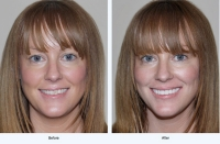 Content Dam Diq En Articles 2014 01 Smilesimplicity Introduces Zero Pain Technique Leftcolumn Article Thumbnailimage File