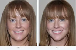 Content Dam Diq En Articles 2014 01 Smilesimplicity Introduces Zero Pain Technique Leftcolumn Article Thumbnailimage File Content Dam Diq En Articles 2014 01 Smilesimplicity Introduces Zero Pain Technique Leftcolumn Article Thumbnailimage File