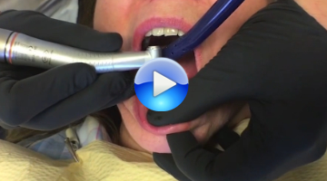 Content Dam Diq En Articles 2016 09 Pearls Enhanced Dr Austin Demos Shofu S Clear Attachment Removal Kit Video Leftcolumn Article Thumbnailimage File