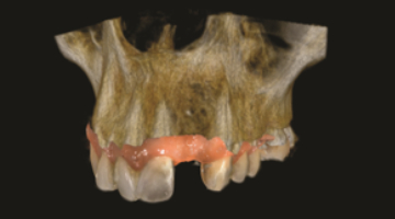 Content Dam Diq En Articles 2017 03 The Benefits Of Adding Prosthetic Driven Implant Planning To Your Practice Leftcolumn Article Thumbnailimage File