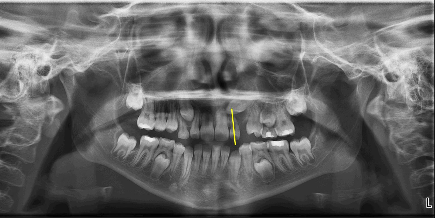 Figure 1: The panoramic radiograph (ProMax, Planmeca) shows how the crown of the maxillary left canine crosses the long axis of the lateral incisor, indicating a potential for canine impaction