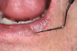 Figure 1: Leukoplakic lesion on lower left lip Figure 1: Leukoplakic lesion on lower left lip