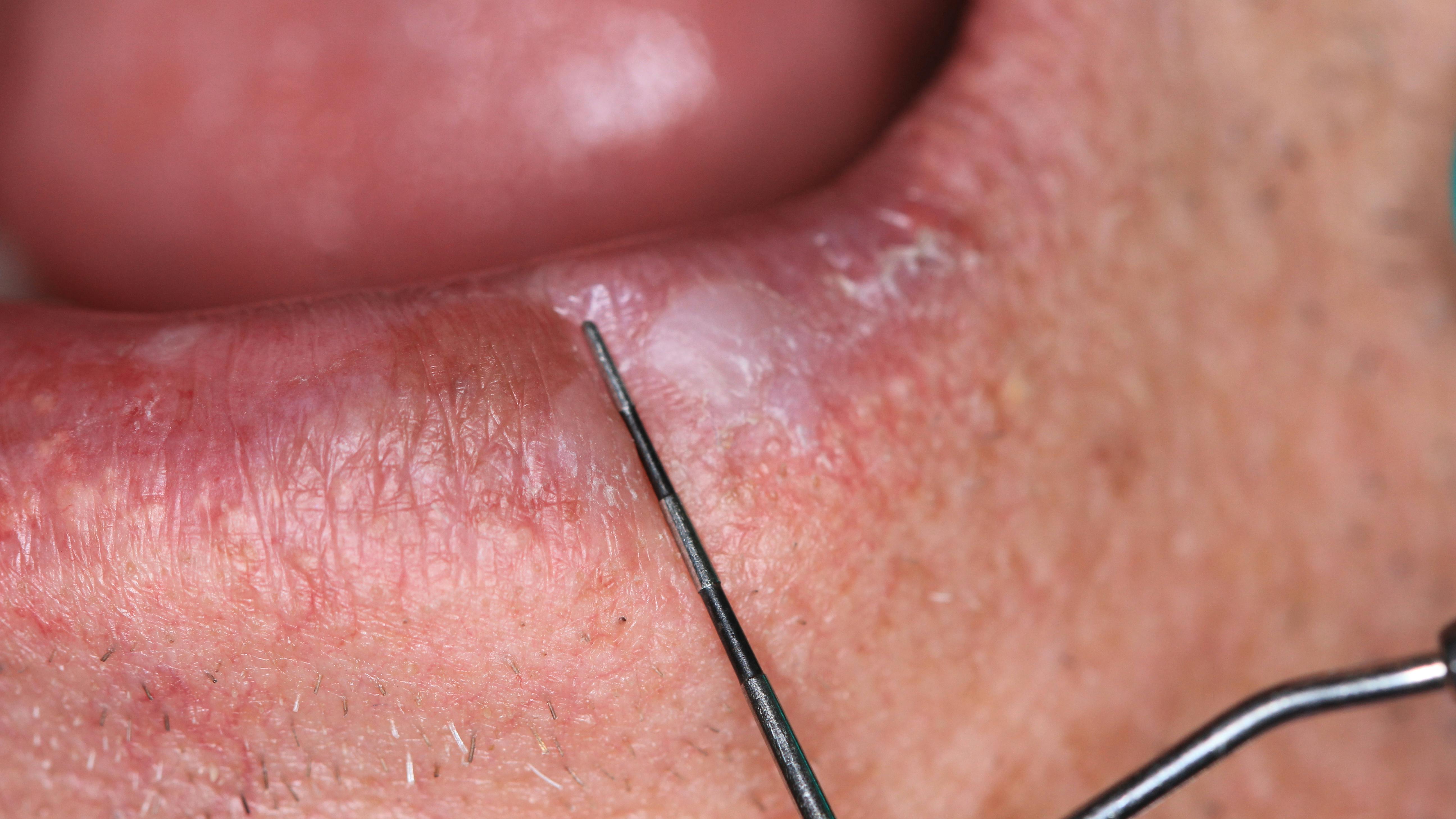 Figure 2: 6 mm x 9 mm irregular-shaped lesion appears white