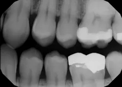 Figure 1: Radiograph from 2016 Figure 1: Radiograph from 2016