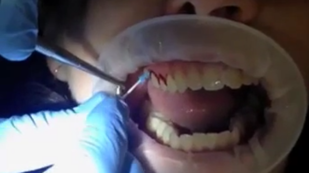 Swedish Wonder Thumb