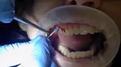 Swedish Wonder Thumb Swedish Wonder Thumb