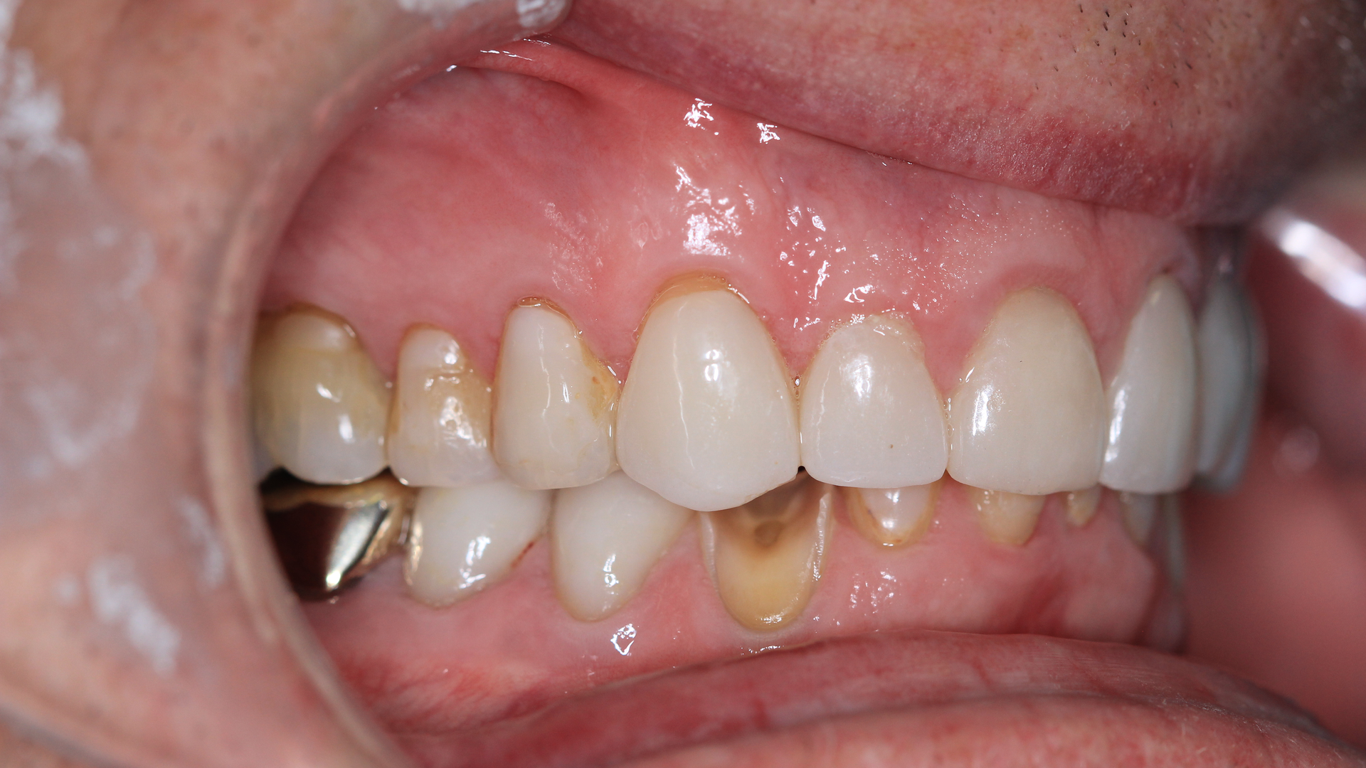 20 Jan23 B Cgividen Primary