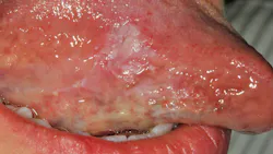 Figure 1: 15 mm x 15 mm leukoplakic lesion on right lateral border of the tongue—oral squamous cell carcinoma Figure 1: 15 mm x 15 mm leukoplakic lesion on right lateral border of the tongue—oral squamous cell carcinoma