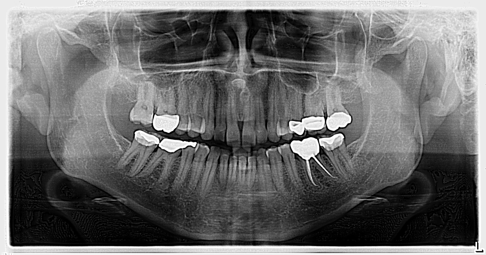 Figure 1: Panoramic radiograph of the radiopaque lesions