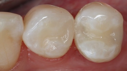 Figure2 Post Op Venus Pearl Venus Diamond 5fbbf0420aa15