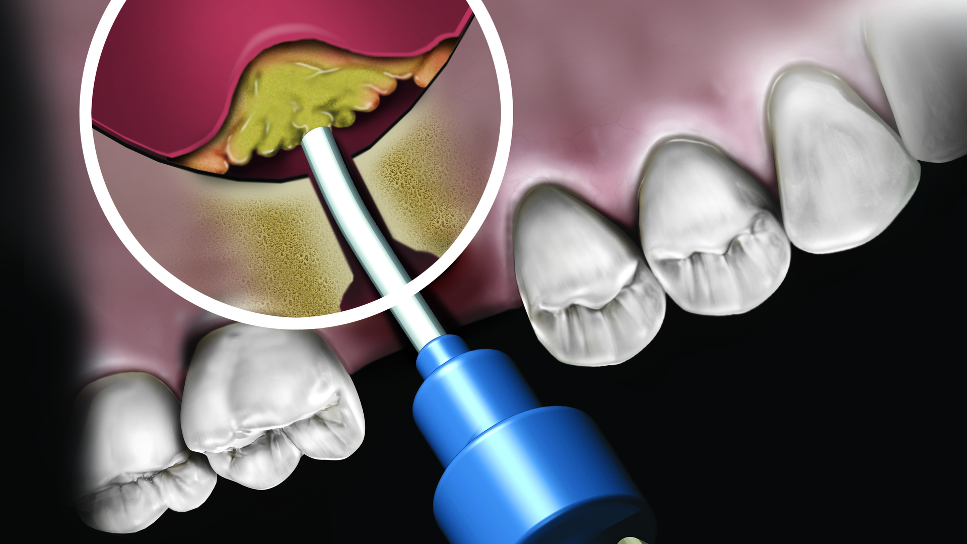 Novabone Sinus Blue 2017