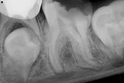 Radiograph of no. 19 in 10-year-old male Radiograph of no. 19 in 10-year-old male