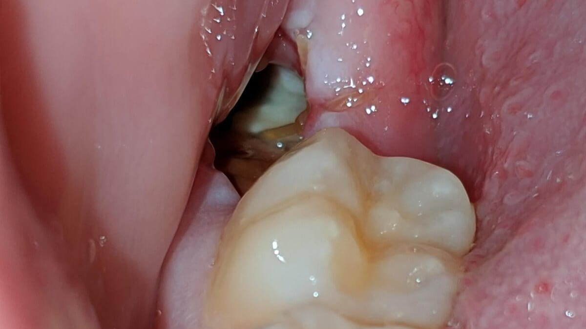 dry socket, alveolar osteitis