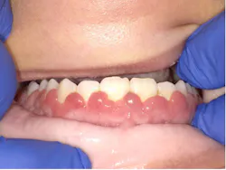 Figure 5: Two-week follow-up: tissue has grown back almost to the original levels Figure 5: Two-week follow-up: tissue has grown back almost to the original levels