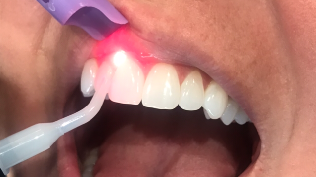 Laser bacterial reduction