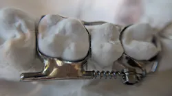 An Anterior Growth Guidance Appliance, or AGGA device, is photographed before it was used by Karan Gill, who wore the device for months and alleges in a lawsuit his teeth were left loose and sensitive. The AGGA’s inventor and manufacturer have denied all liability in that lawsuit. An Anterior Growth Guidance Appliance, or AGGA device, is photographed before it was used by Karan Gill, who wore the device for months and alleges in a lawsuit his teeth were left loose and sensitive. The AGGA’s inventor and manufacturer have denied all liability in that lawsuit.