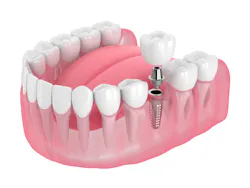 Dental Implant Image Dental Implant Image