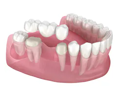Dental Tooth Bridge Image Dental Tooth Bridge Image
