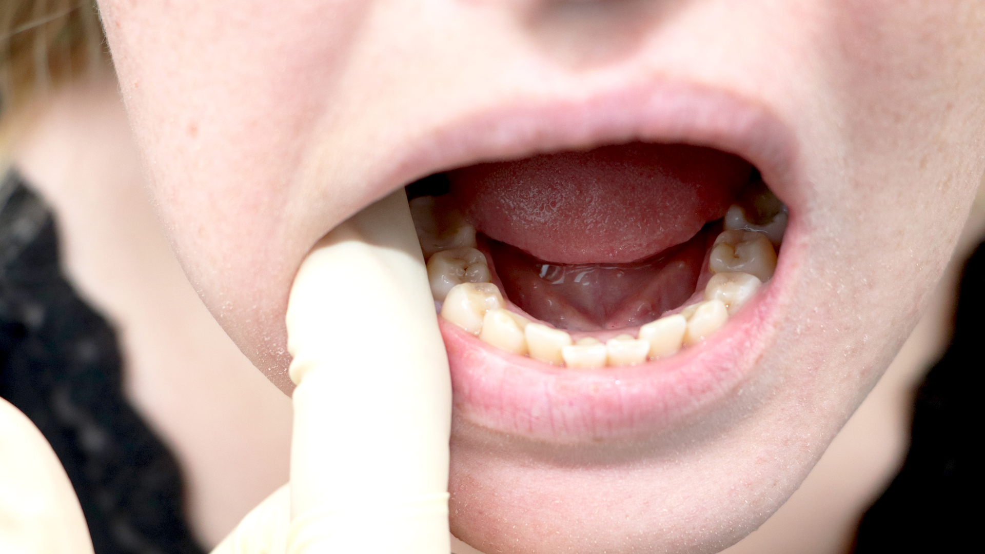 Dental hygienists can identify early signs of life-threatening conditions and pathologies, including oral cancer. Learn what to look during an exam.