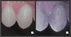 Left: Teeth just after brushing in natural light. Right: After swishing with Lumorinse mouth rinse; Lumorinse attaches to plaque bacteria. Lumorinse is a green, photosensitive mouthwash that is swished in the mouth before application of the Lumoral light. Near-infrared imaging shows that even the best toothbrushing leaves a lot of residual plaque. Left: Teeth just after brushing in natural light. Right: After swishing with Lumorinse mouth rinse; Lumorinse attaches to plaque bacteria. Lumorinse is a green, photosensitive mouthwash that is swished in the mouth before application of the Lumoral light. Near-infrared imaging shows that even the best toothbrushing leaves a lot of residual plaque.