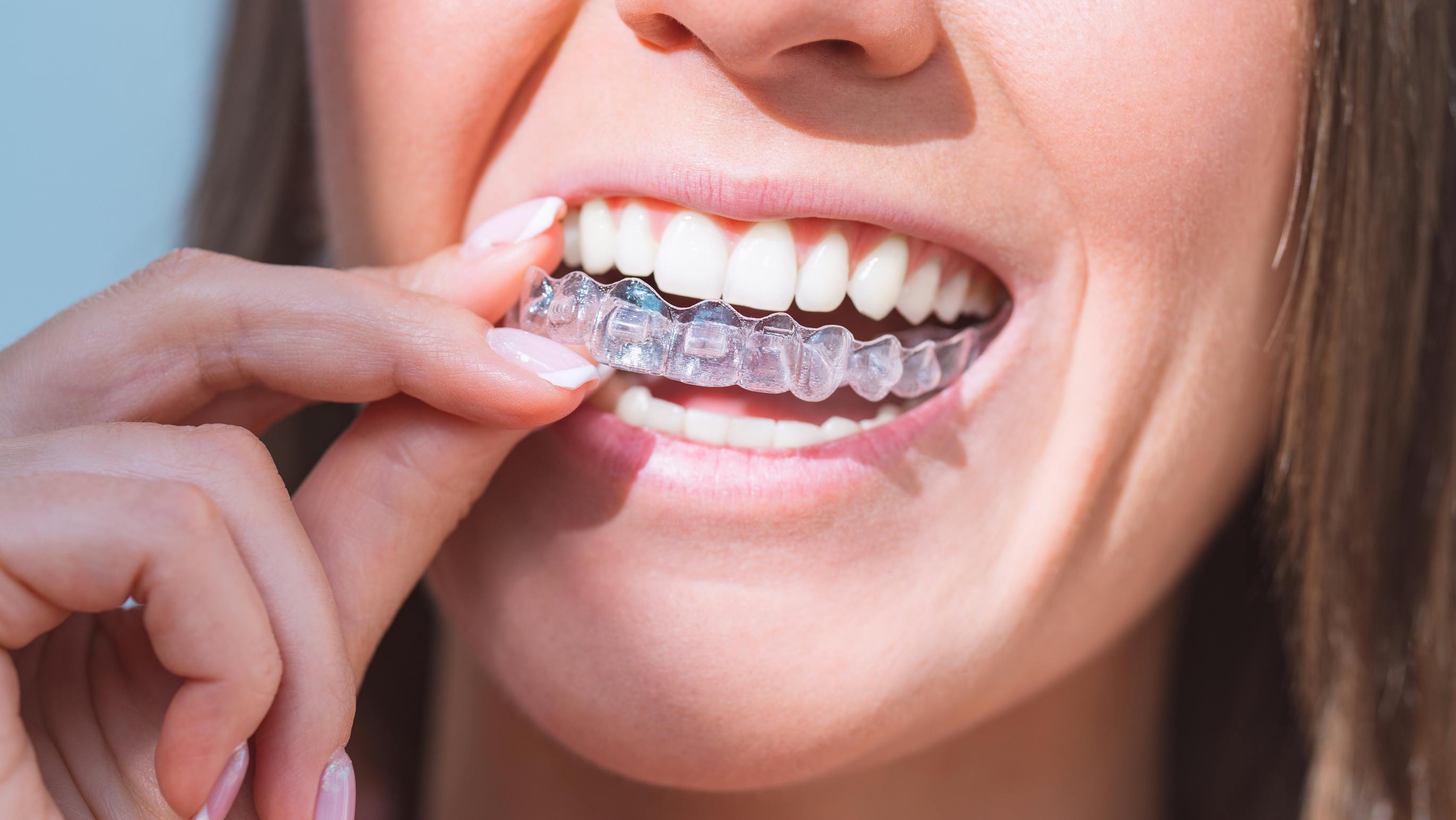 Person wearing dental aligners