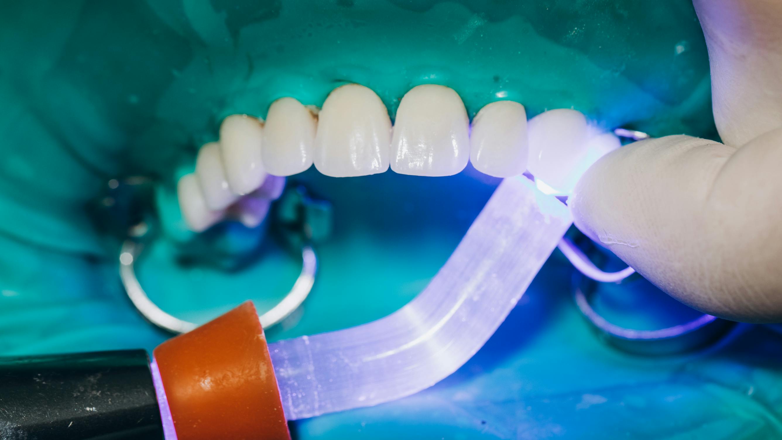 Person getting veneers