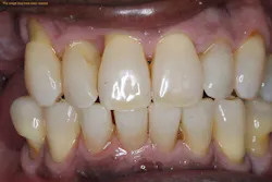 After periodontal desiccation After periodontal desiccation