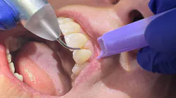 dental lasers dental lasers