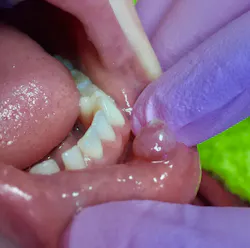 likely diagnosis is oral mucocele likely diagnosis is oral mucocele