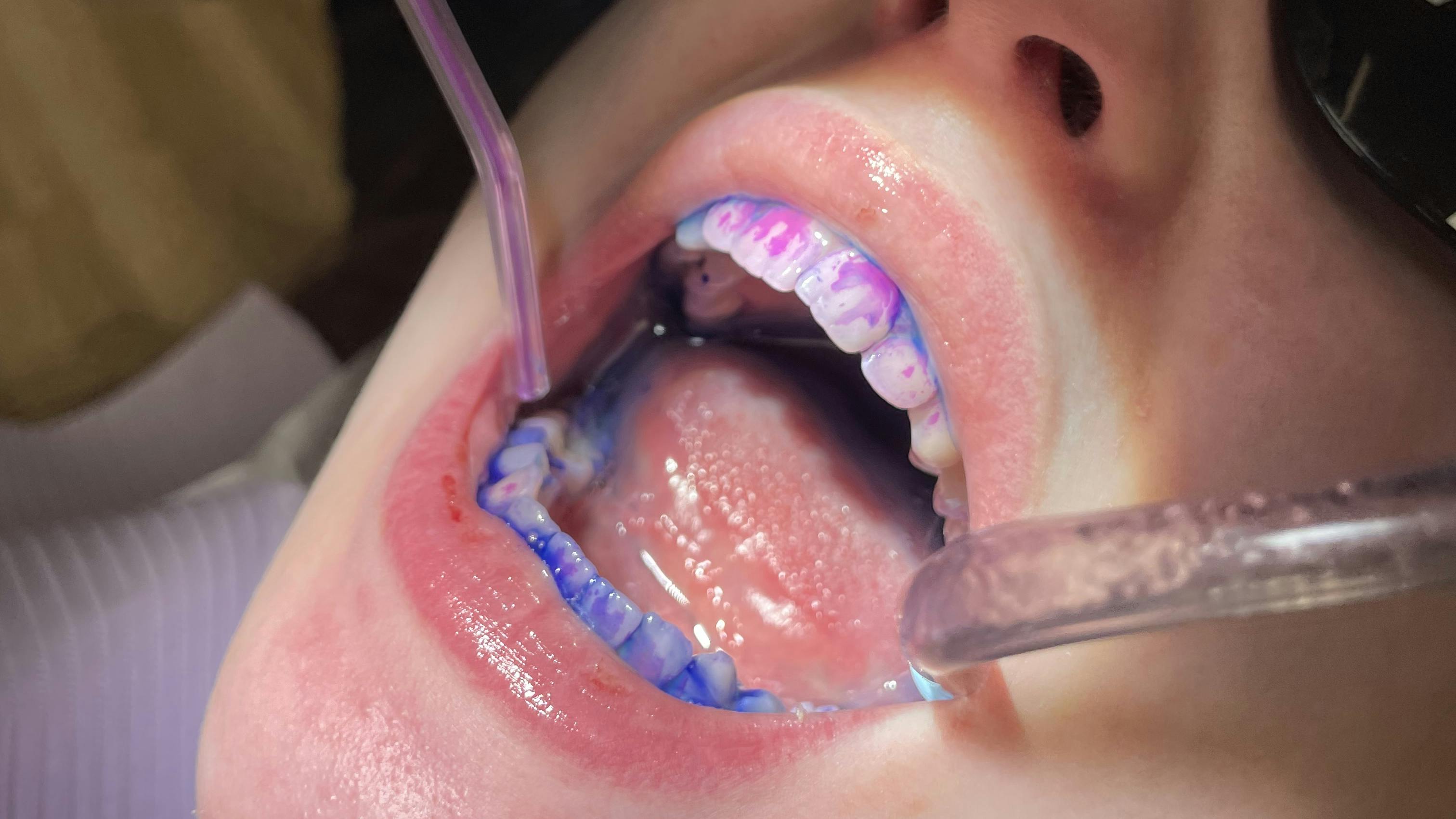 disclosing solution for dental patient education