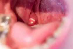 Tonsil stones Tonsil stones