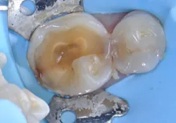 Restoration using Activa BioActive Bulk Flow. Top, pre-op, and below, pre-op x-ray. Images courtesy of Dr. Raymond Zhu. Restoration using Activa BioActive Bulk Flow. Top, pre-op, and below, pre-op x-ray. Images courtesy of Dr. Raymond Zhu.