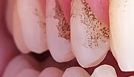 black tartar on teeth